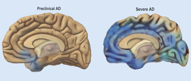 brian shrinkage in alzheimer's disease