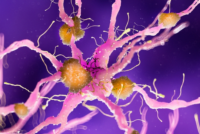 Illustration of yellow clumps on pink nerve cells